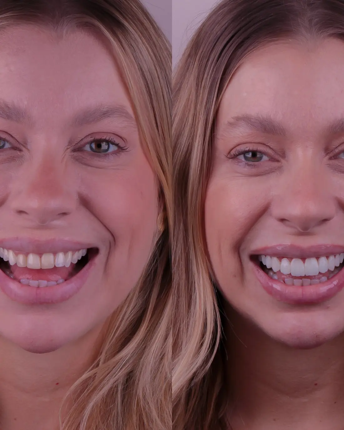 Comparativo real de sorriso antes e depois